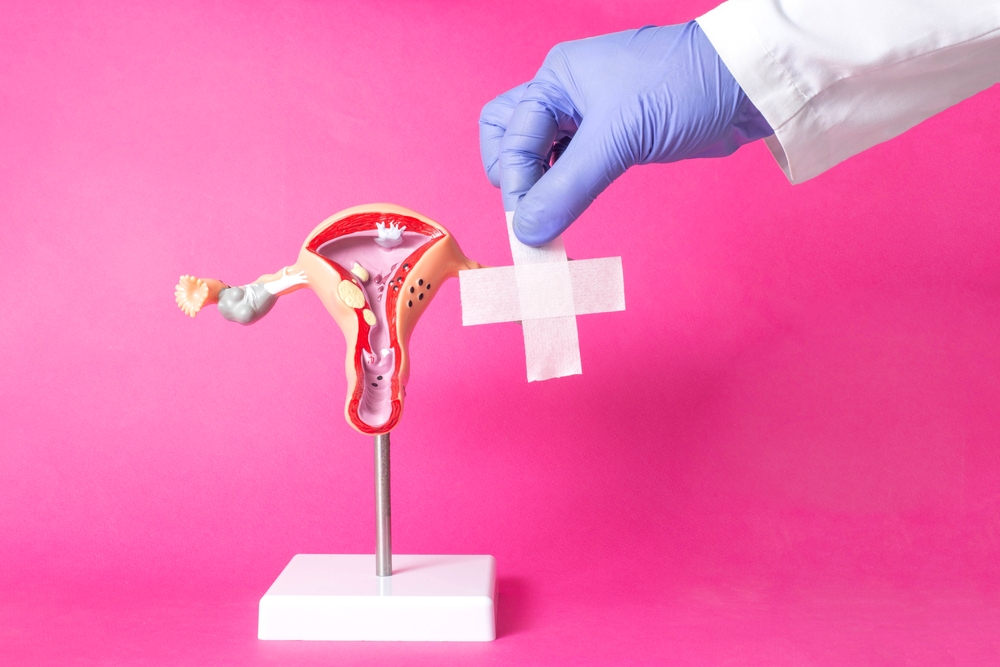 Model of uterine fibroids.